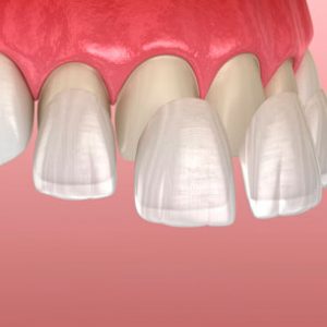 Clinica Medicina Dentaria - Antonio Cardoso - Servicos Facetas Dentárias