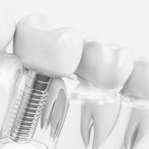 Clinica Medicina Dentaria - Antonio Cardoso - Servicos Implantologia