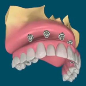 Clinica Medicina Dentaria - Antonio Cardoso - Servicos Protese Dentaria Hibrida